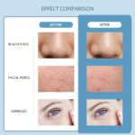 Professional Ultrasonic Skin Scrubber | 4-in-1 Deep Cleansing & Lifting Facial Device - الصورة 5