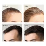 MediQ Bio-Needle Derma Stamp | Advanced Skin Radiance & Vitality Tool - Image 6